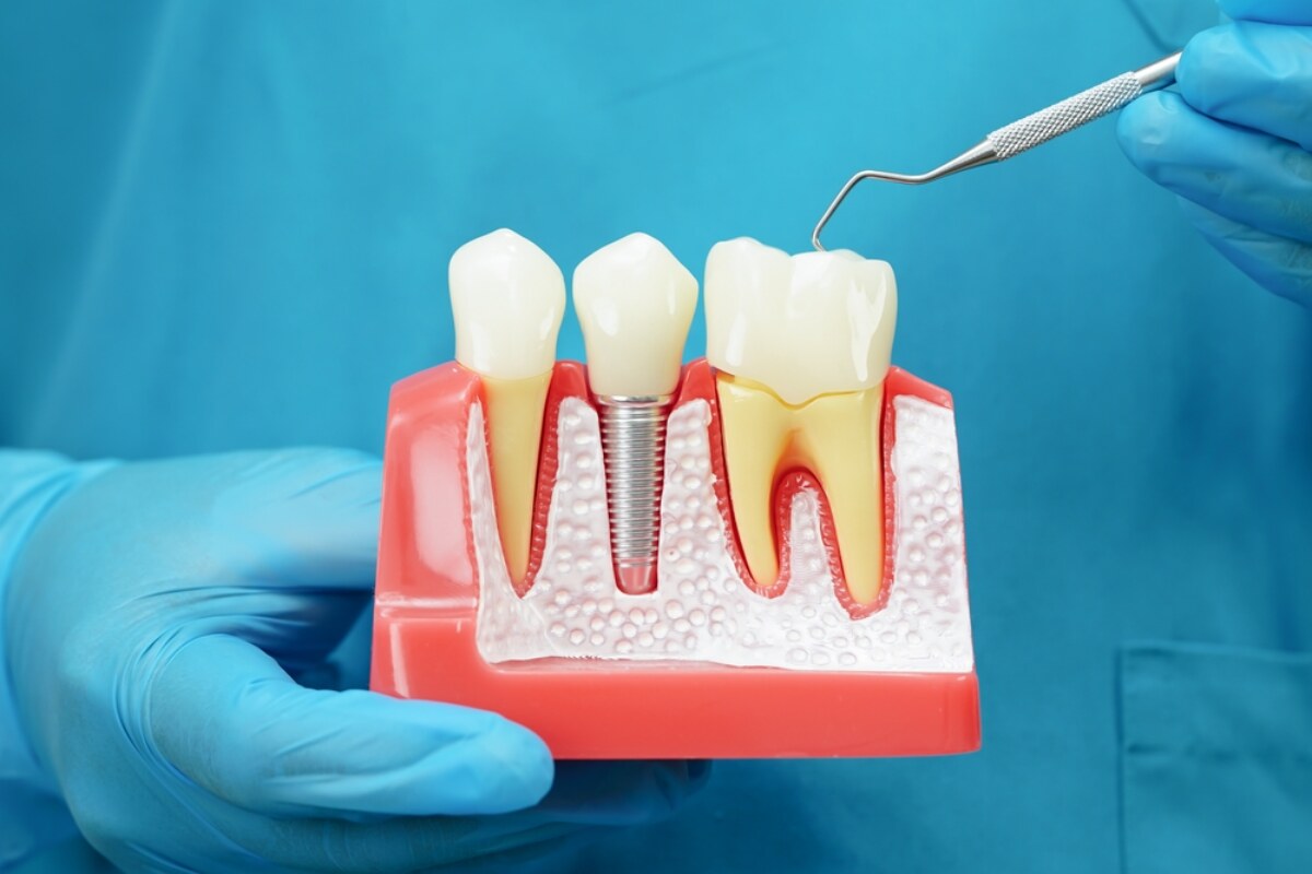 how to care for your dental crown to make it last longer