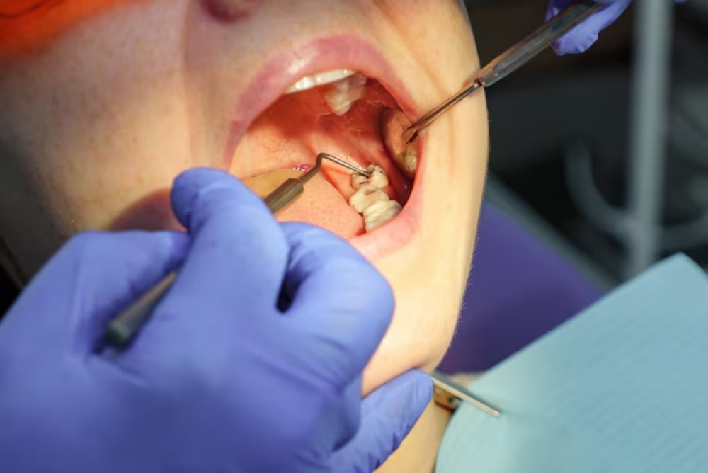 A Simple Guide to Wisdom Teeth Removal and Recovery