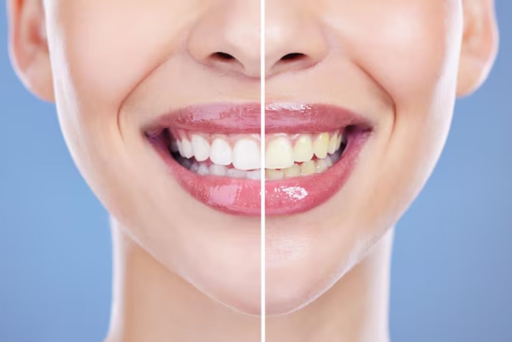 Does Zoom Teeth Whitening Cause Sensitivity